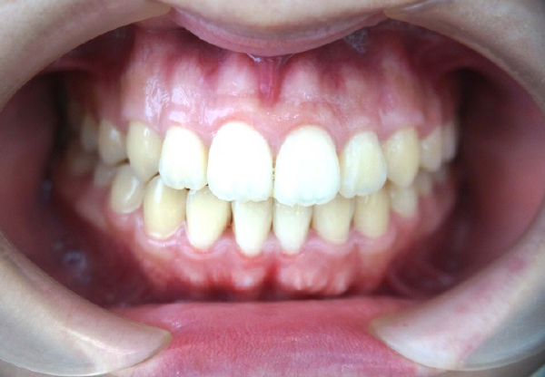 口腔内 治療後